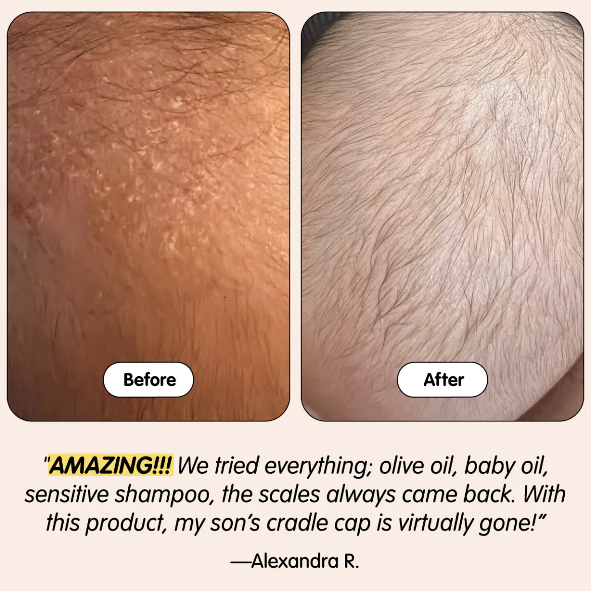 Bye-Bye Cradle Cap Bundle